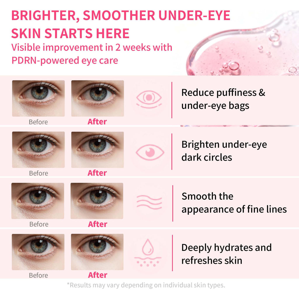Maskiss PDRN Under Eye Patches (25 Pairs), Tri-Color Eye Gel Pads with Retinol Caffeine, Eye Masks for Dark Circles Puffy Eyes Wrinkles, Collagen Self Care Gifts for Women